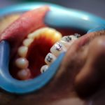 Por qué no retirar la ortodoncia antes de tiempo